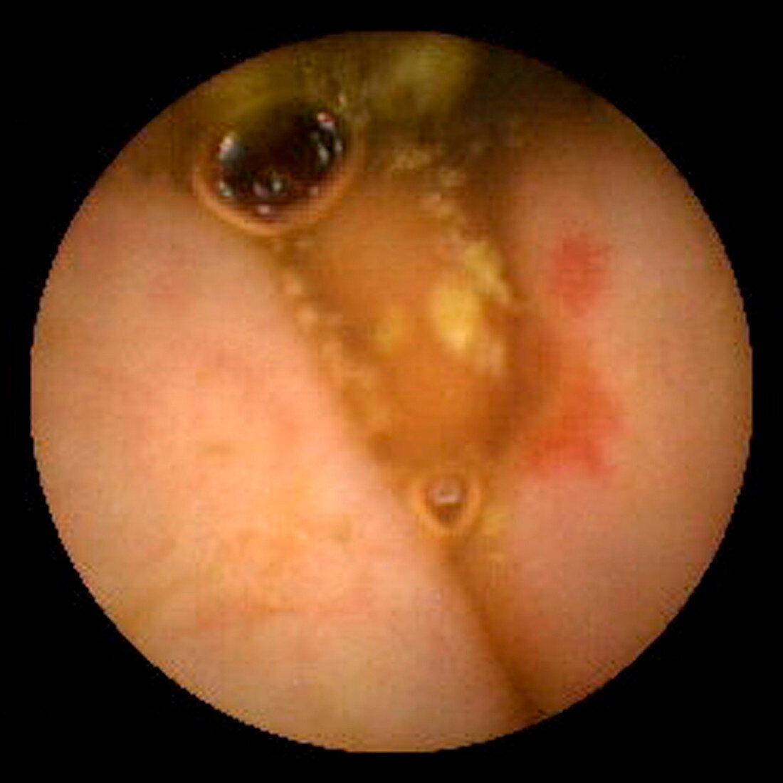 Angiodysplasia of the colon,pill camera