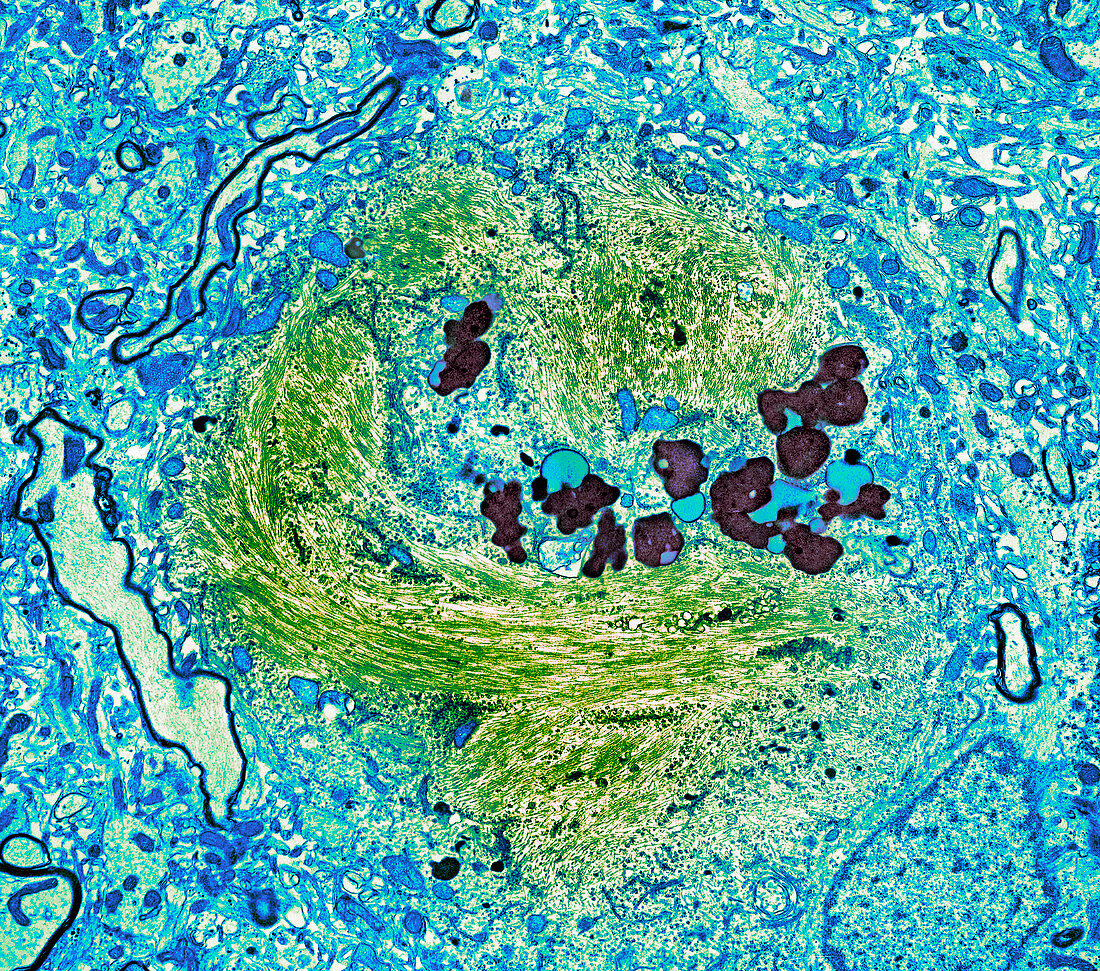 Alzheimer's disease brain cell,TEM