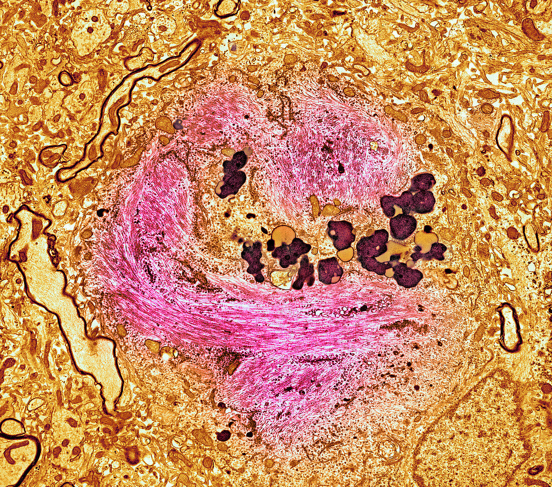 Alzheimer's disease brain cell,TEM