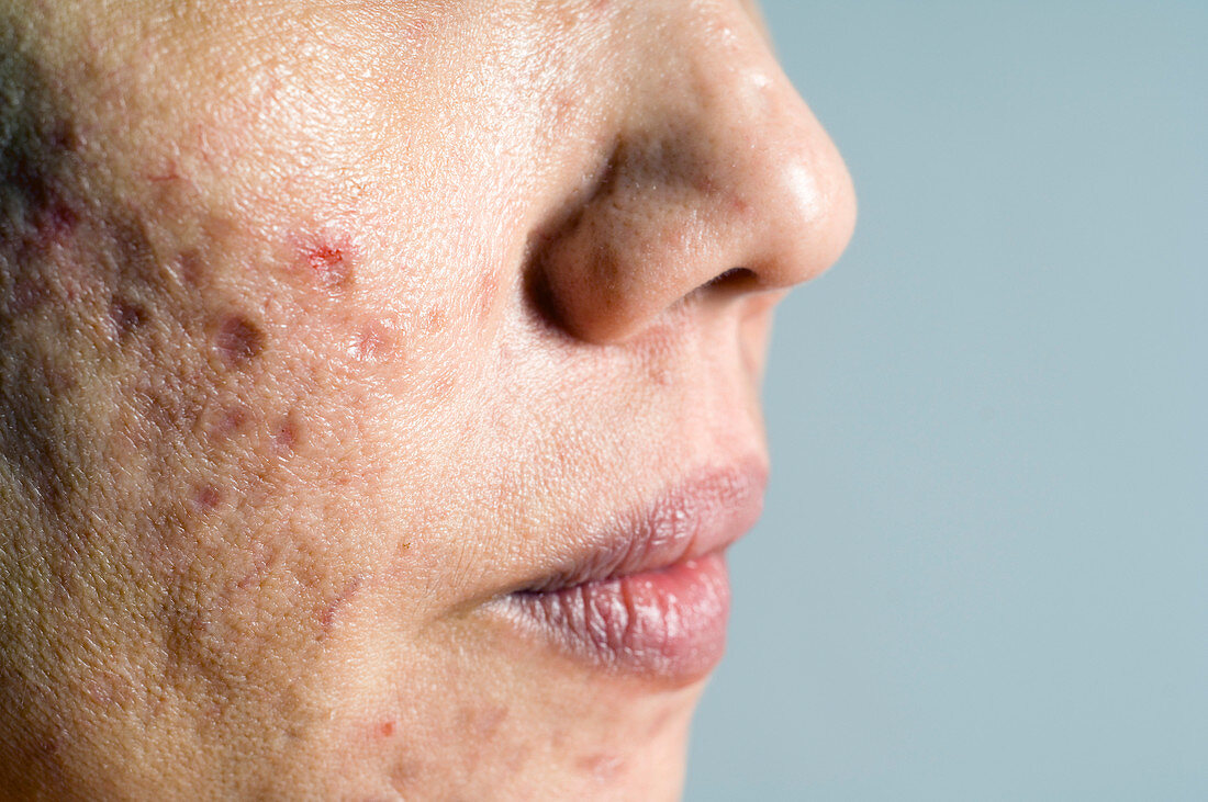 Acne scars