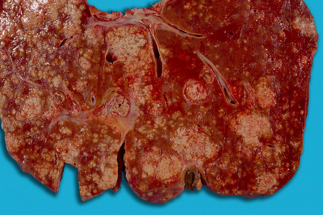 Liver infection and abscess formation