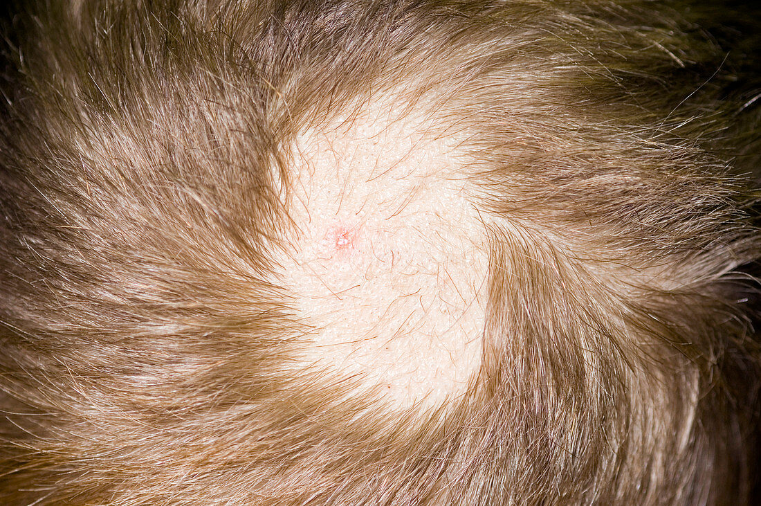 Traction alopecia of the scalp