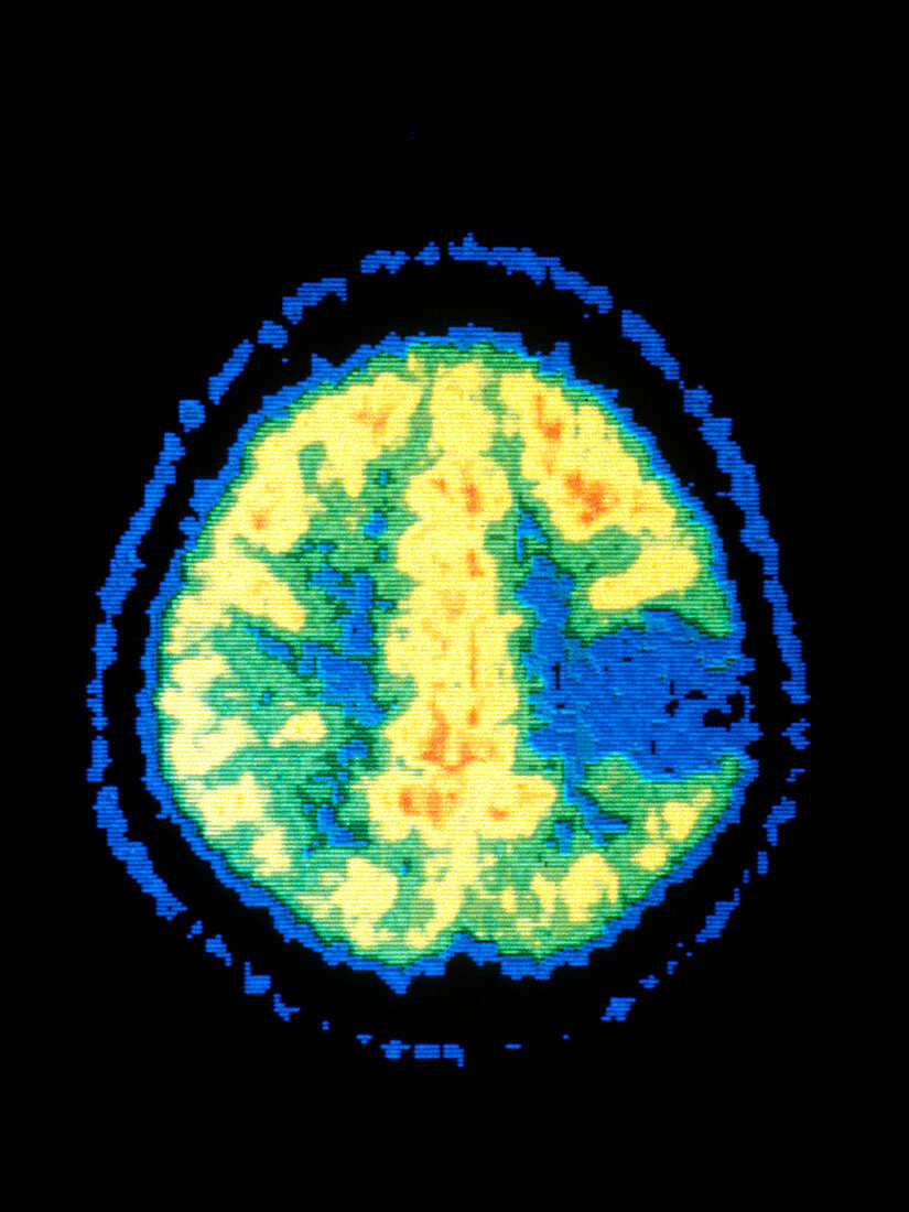 Benign astrocytoma,PET scan