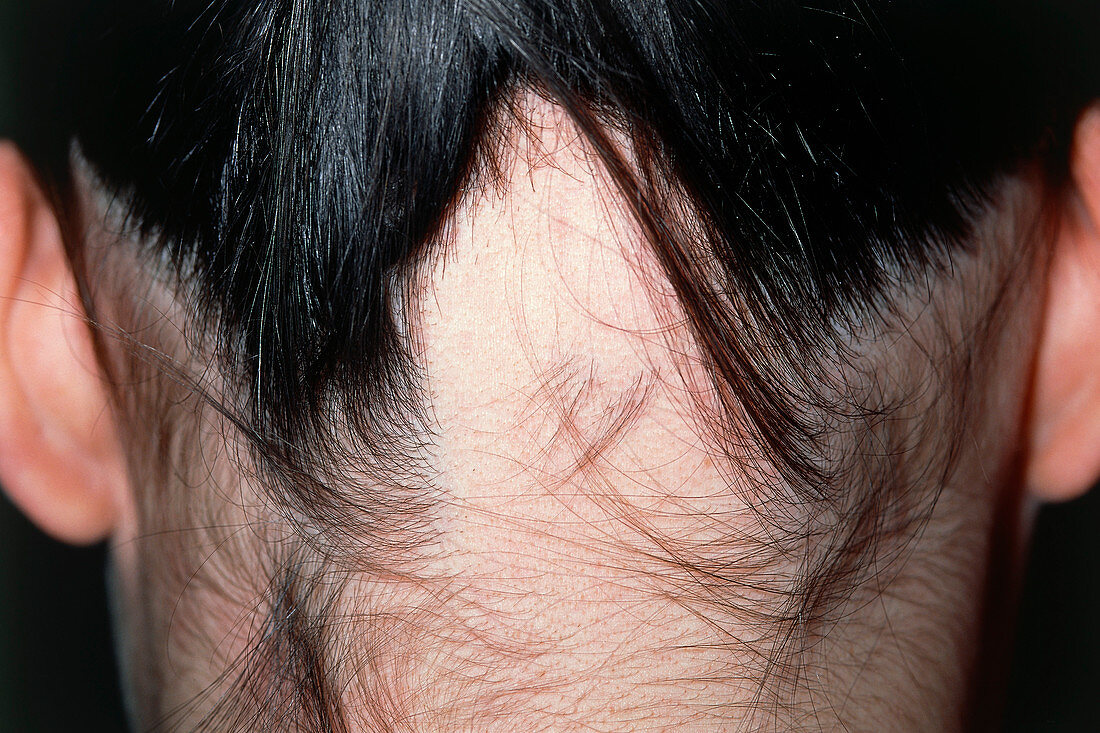Alopecia areata hair loss