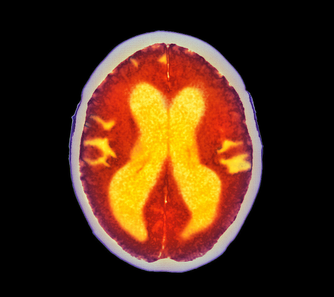 Alzheimer's disease brain,coloured CT scan