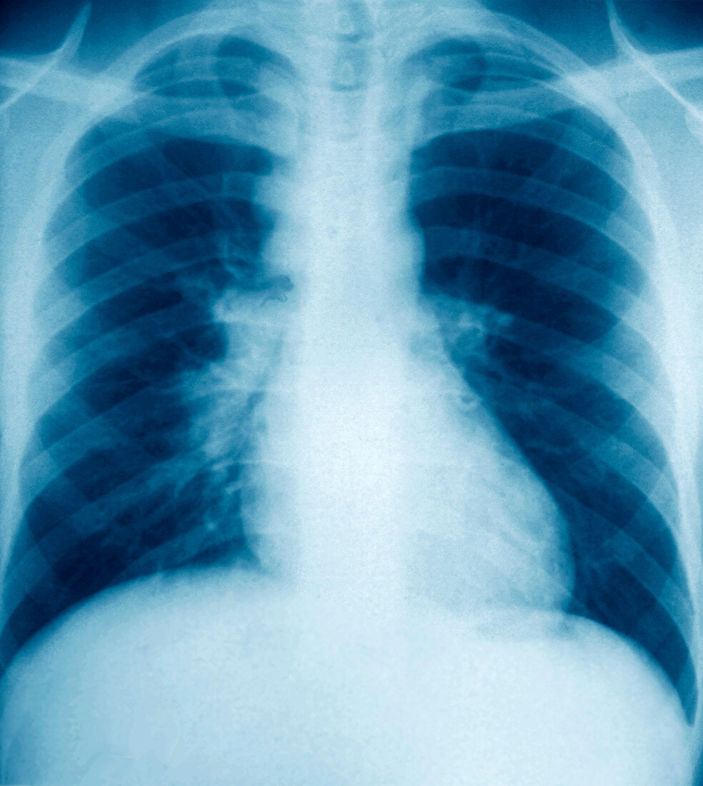 Glandular disease,lung X-ray