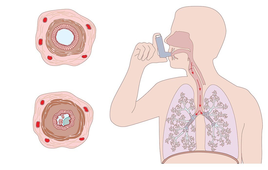 Asthma pathology and treatment,diagram