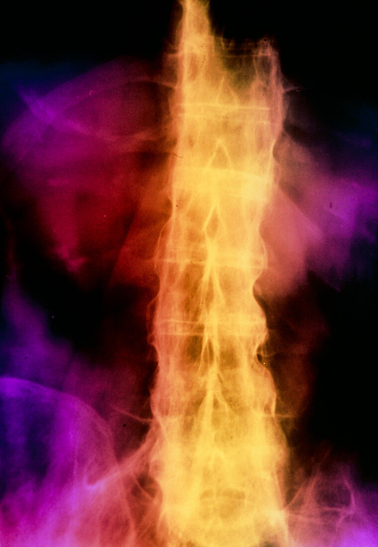 False-colour spinal X-ray: ankylosing spondylitis