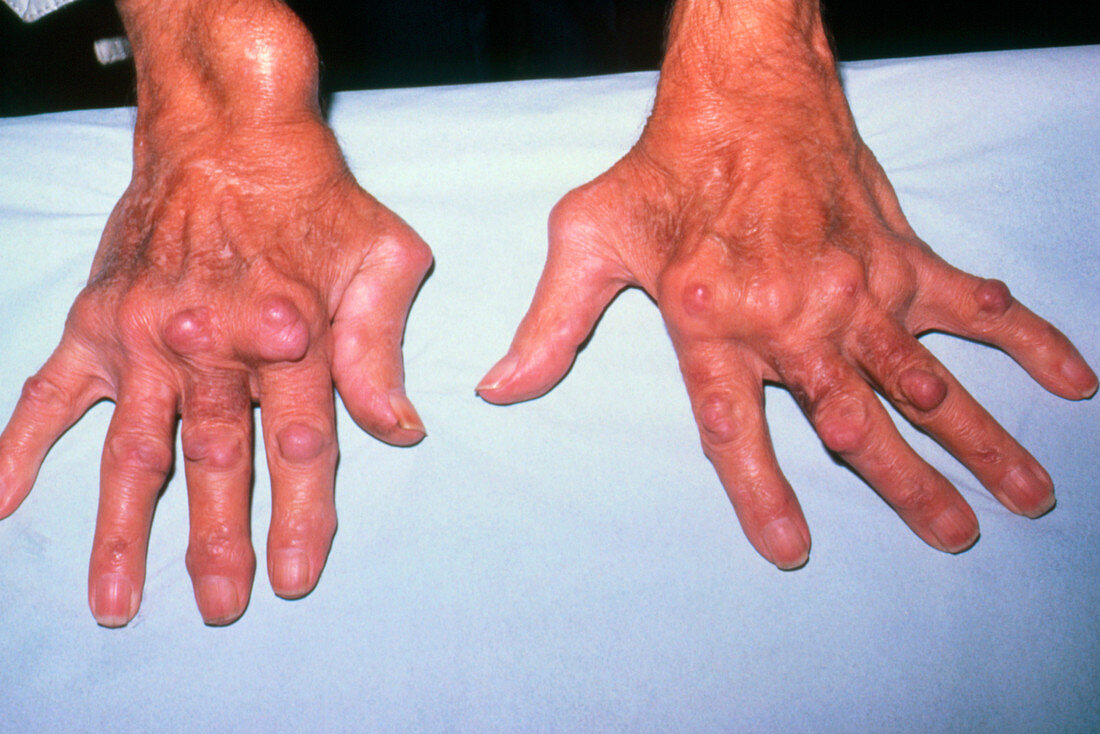 Hands deformed by rheumatoid arthritis