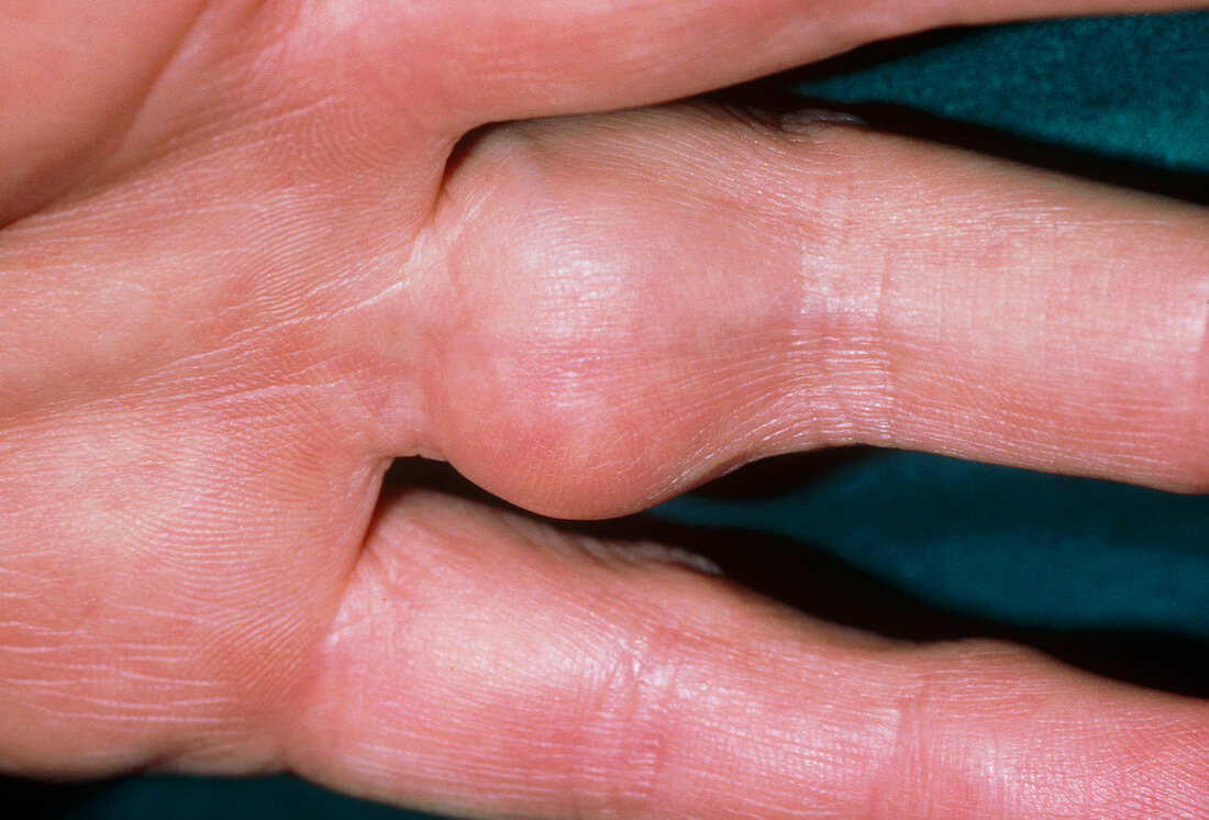Clinical photo of synovitis in finger joint