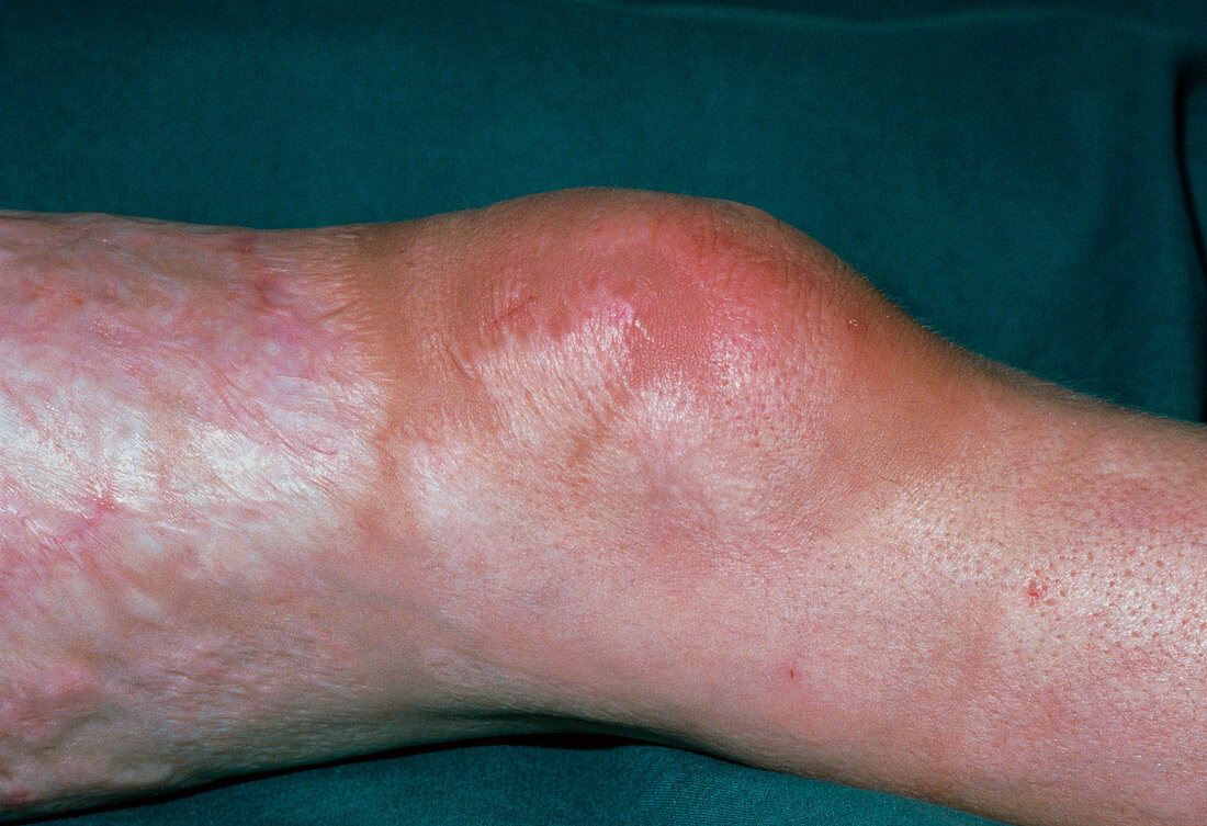 Close up: Acute non-septic monoarthritis of knee