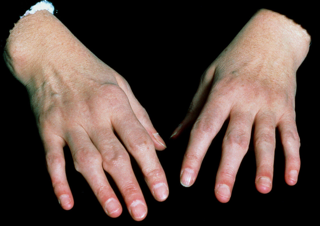 Hands of a patient with rheumatoid arthritis