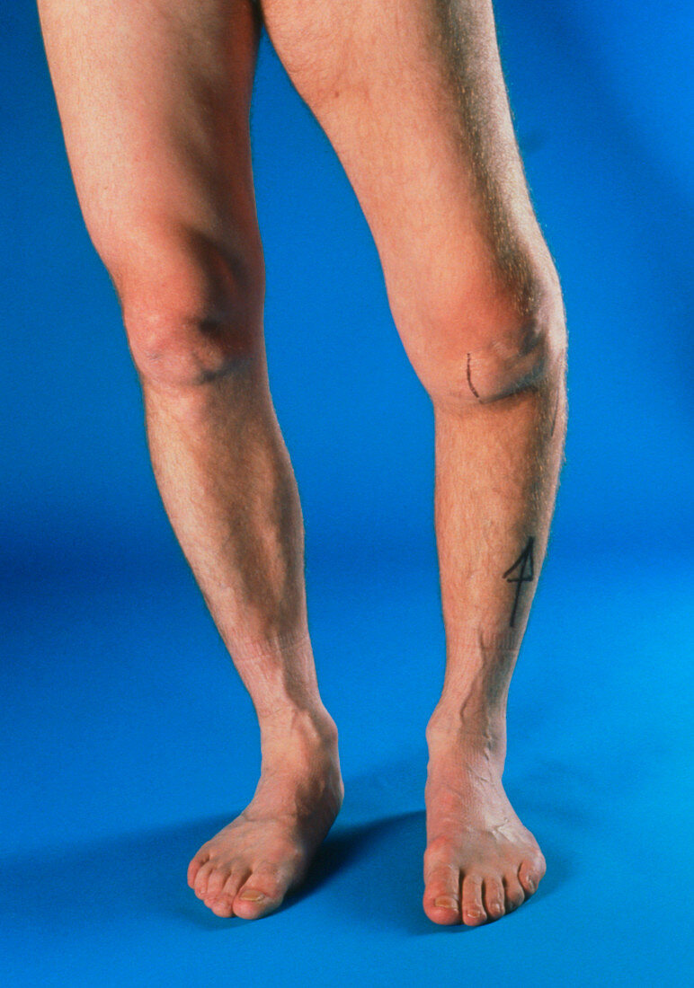 Severe osteoarthritis in the left knee