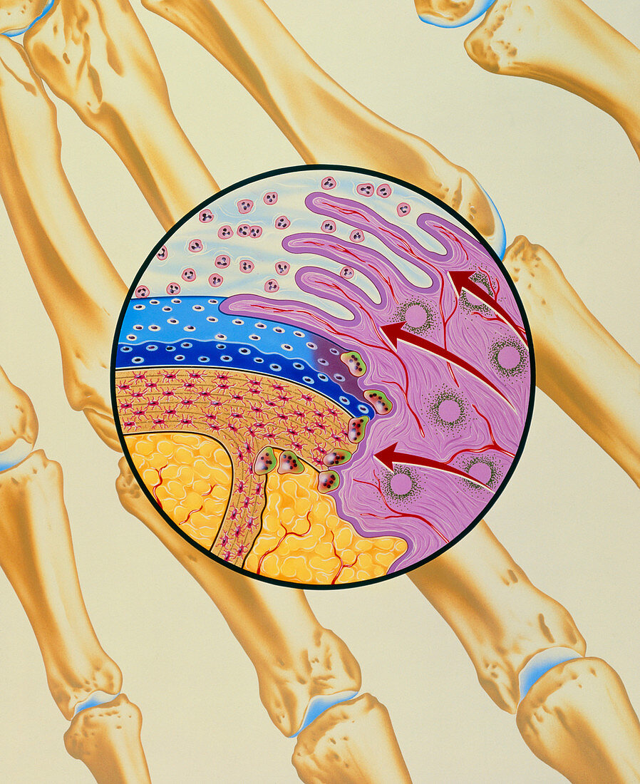 Artwork of the mechanism of rheumatoid arthritis