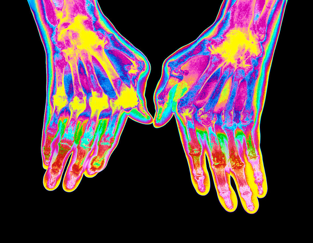 Coloured X-ray of hands with rheumatoid arthritis