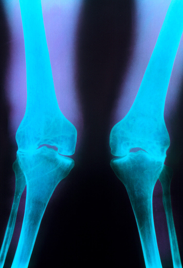 X-ray of knee joints with rheumatoid arthritis