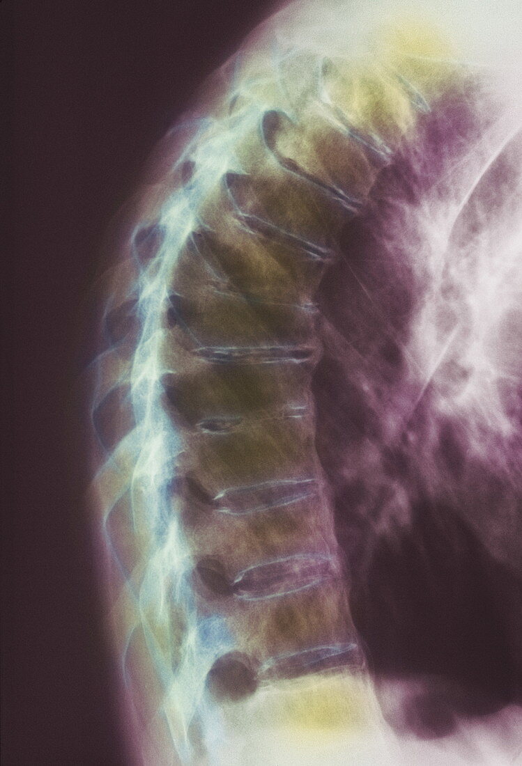 Ankylosing spondylitis X-ray