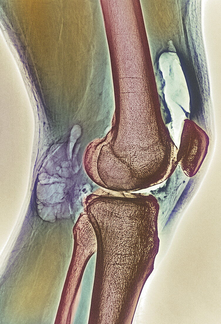 Osteoarthritic knee X-ray