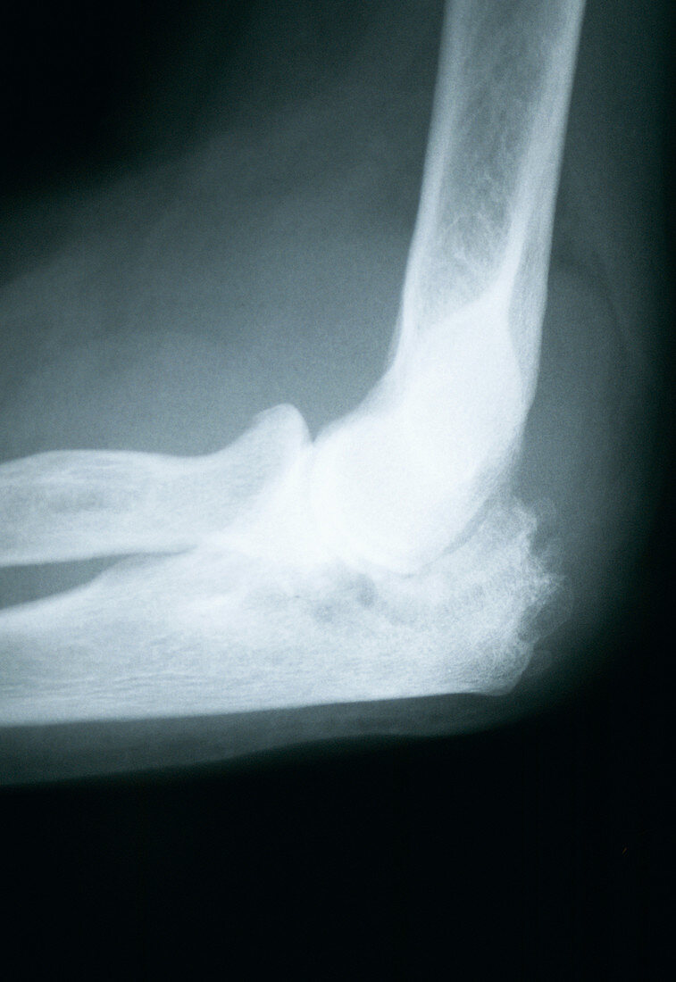 Osteoarthritis of elbow