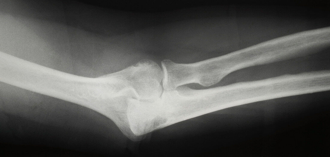 Arthritic elbow,X-ray