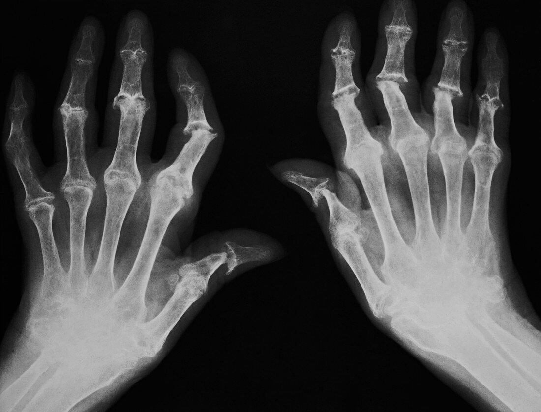 Arthritic hands,X-ray