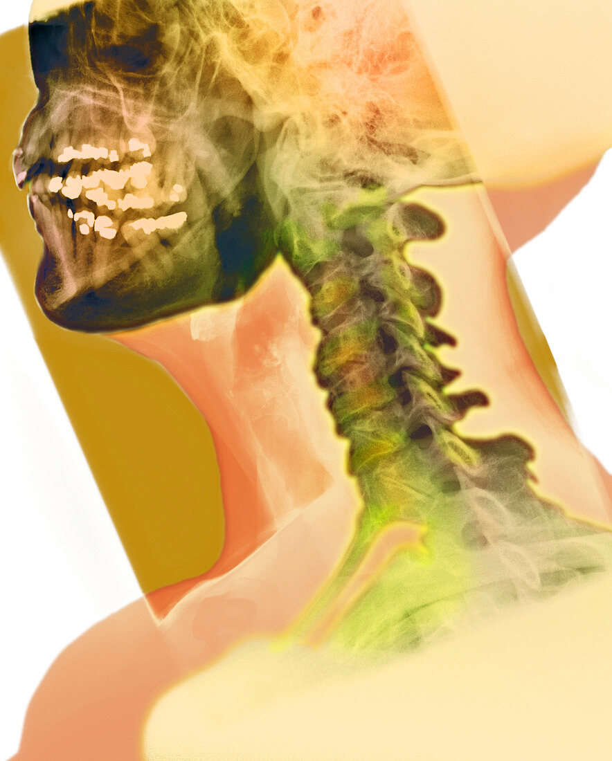 Osteoarthritis of the neck,X-ray