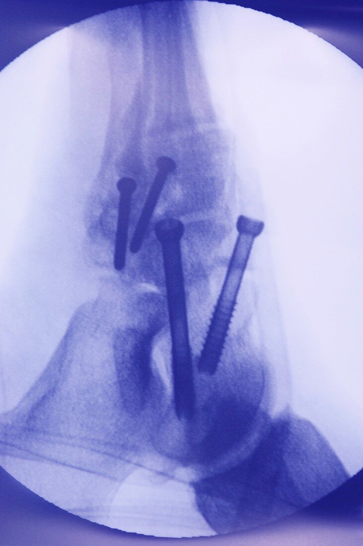 Pinned ankle,X-ray