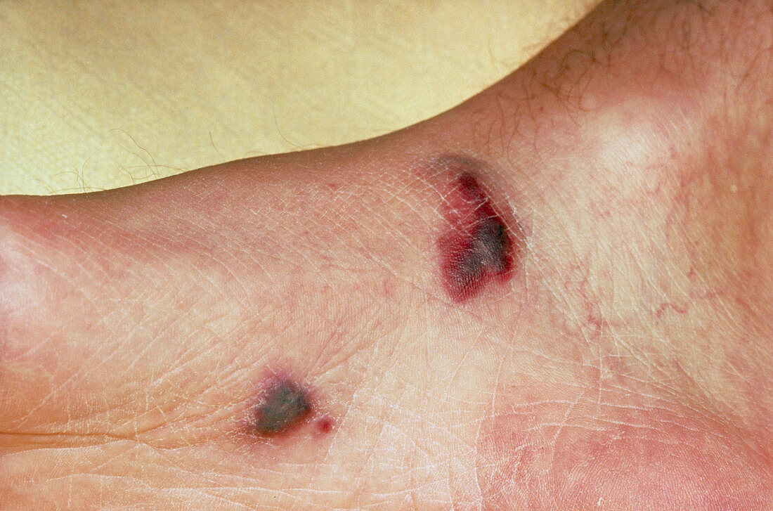 Kaposi's sarcoma on the foot of an AIDS patient