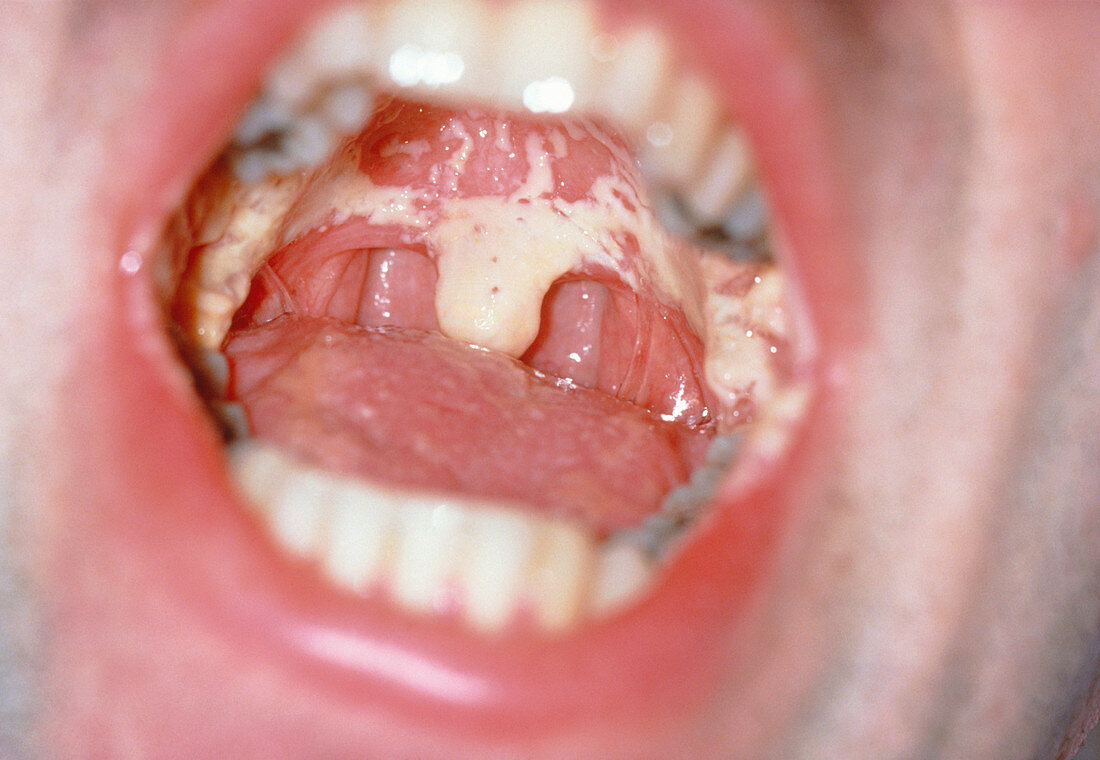 Mouth of an AIDS patient showing oral candidiasis