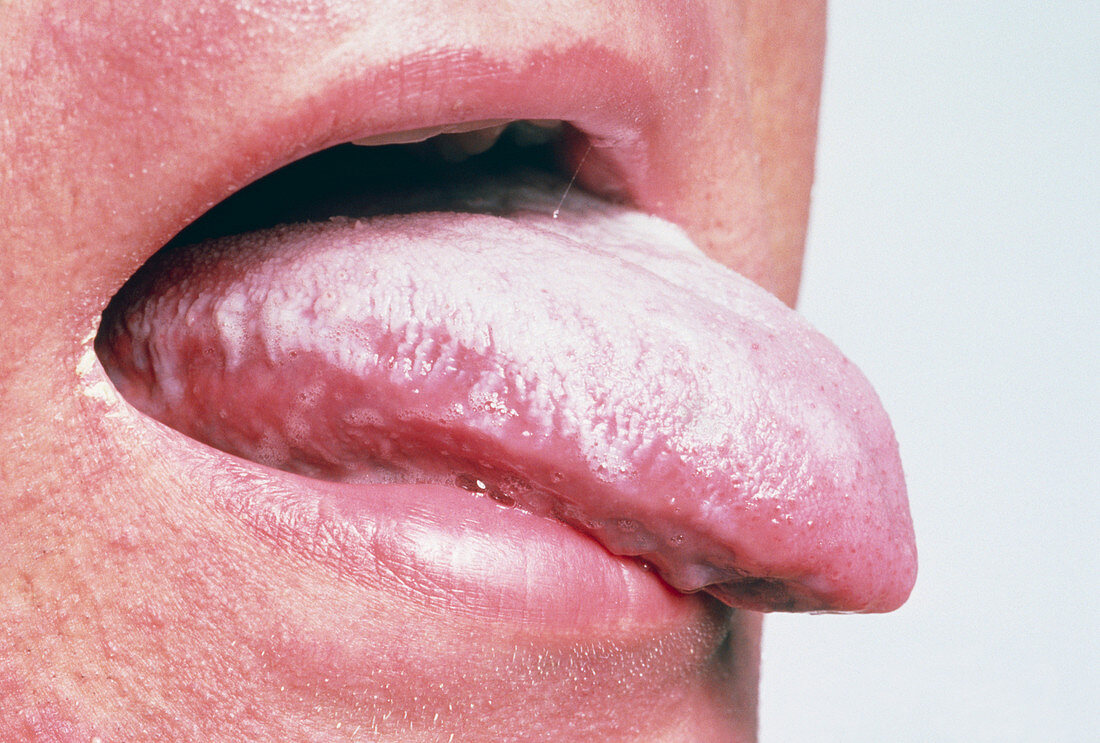 Tongue of an AIDS patient showing oral candidiasis
