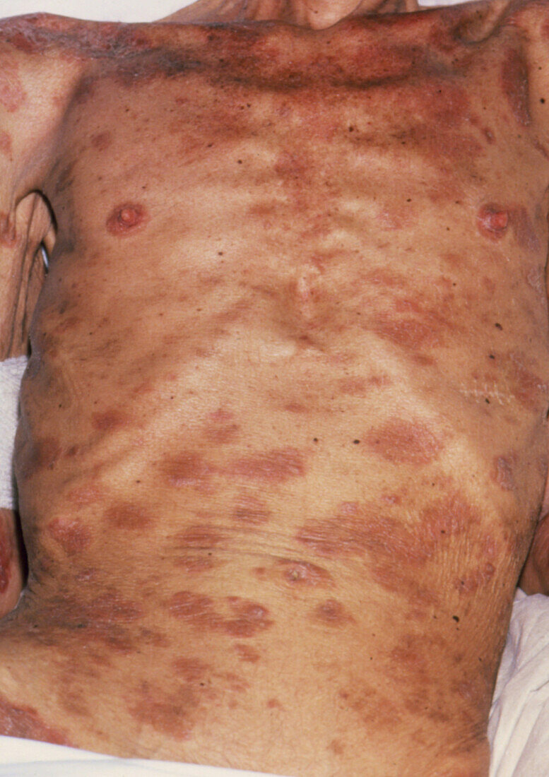 Seborrhoeic dermatitis & emaciation due to AIDS