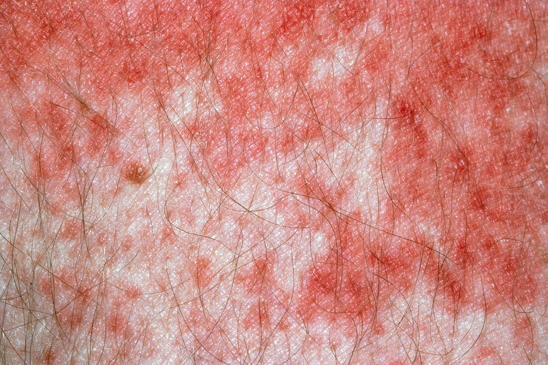 Scabies rash on hand of AIDS patient