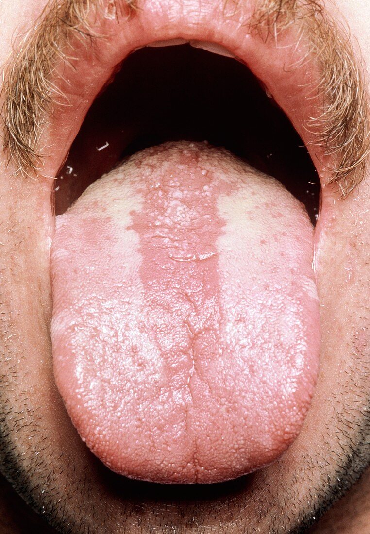 Hairy leukoplakia & candida on tongue in AIDS