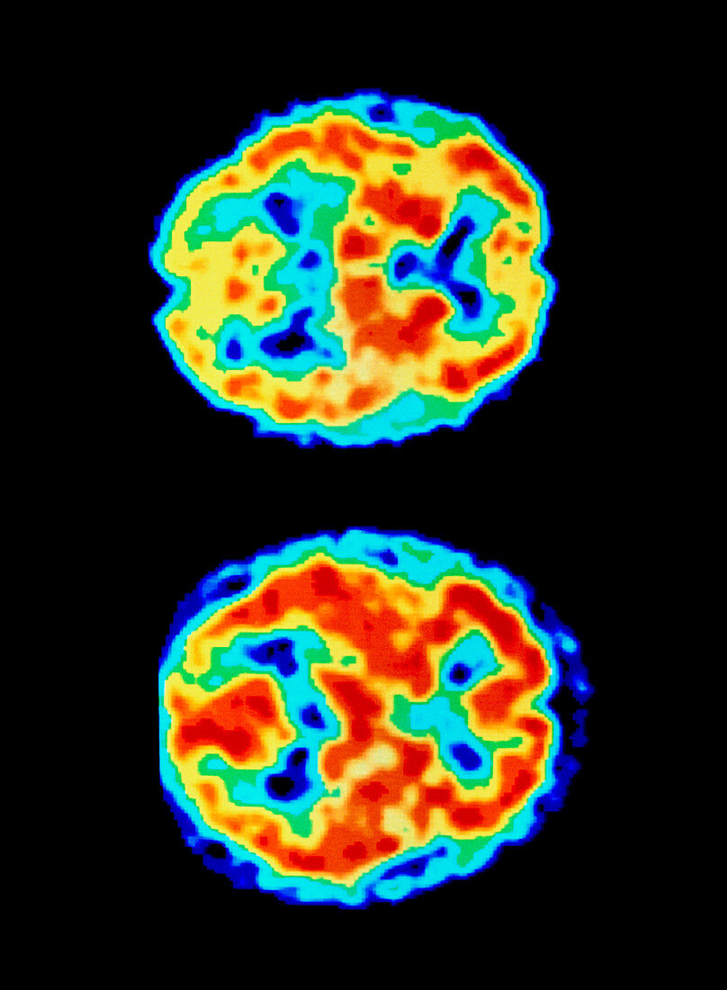 Coloured PET scan of a brain in AIDS dementia