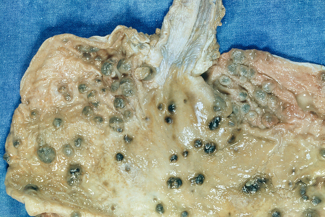 Kaposi's sarcoma of the stomach