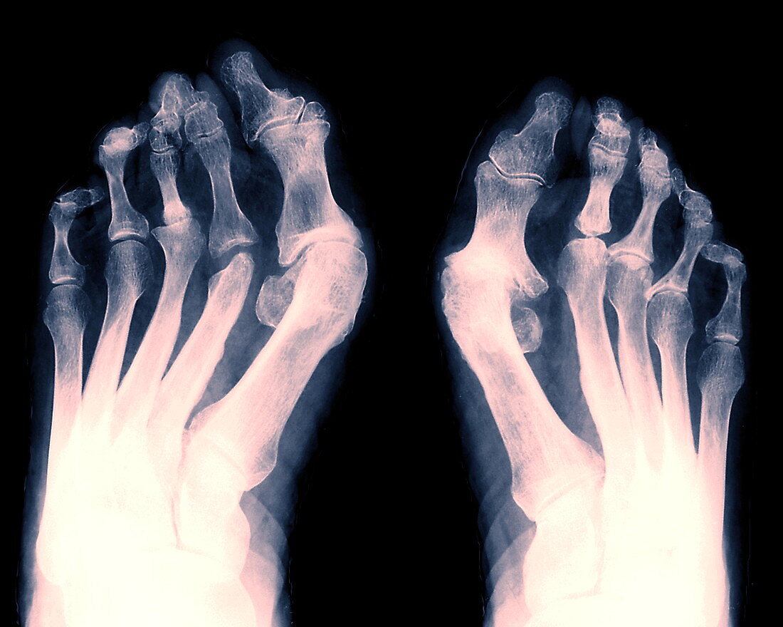 Arthritic feet,X-ray