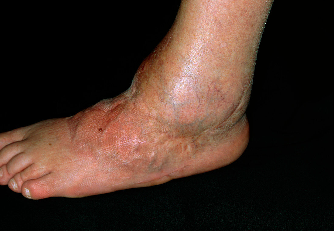 Arthritis of the ankle