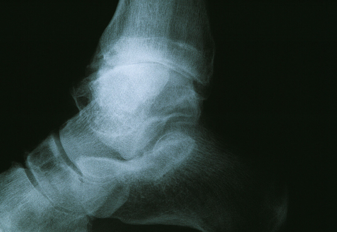 Osteoarthritis of the ankle,X-ray