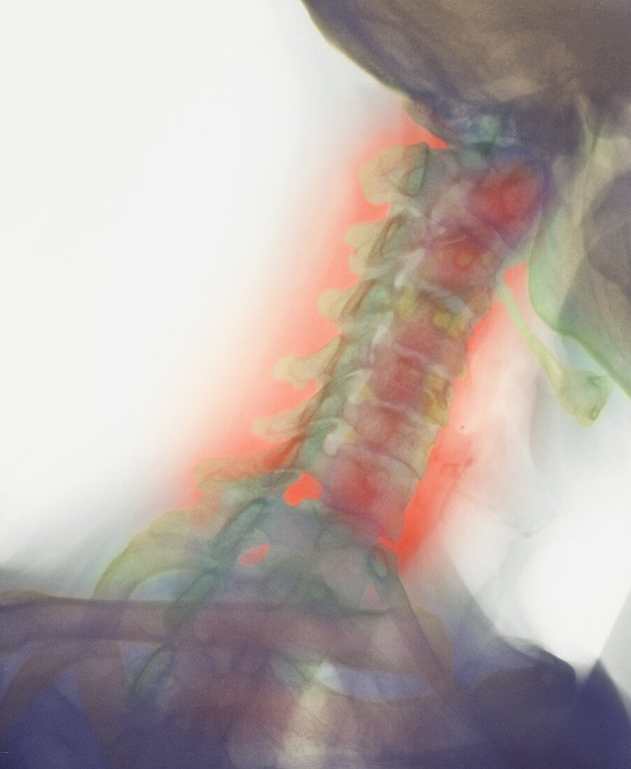 Osteoarthritis of neck,X-ray