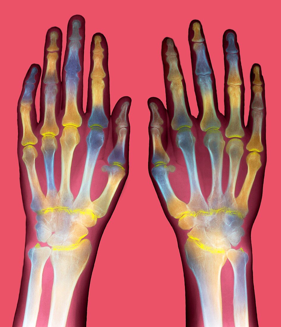 Arthritic hands,X-ray