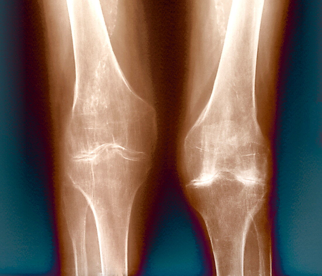 Arthritic knees,X-ray