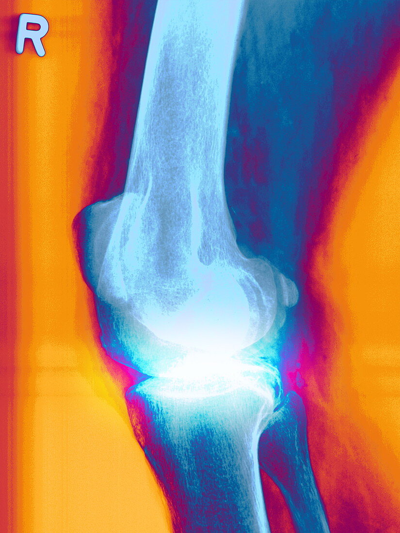 Arthritic knee