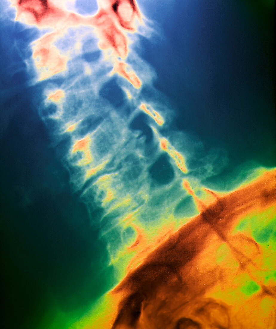 Arthritic neck,X-ray