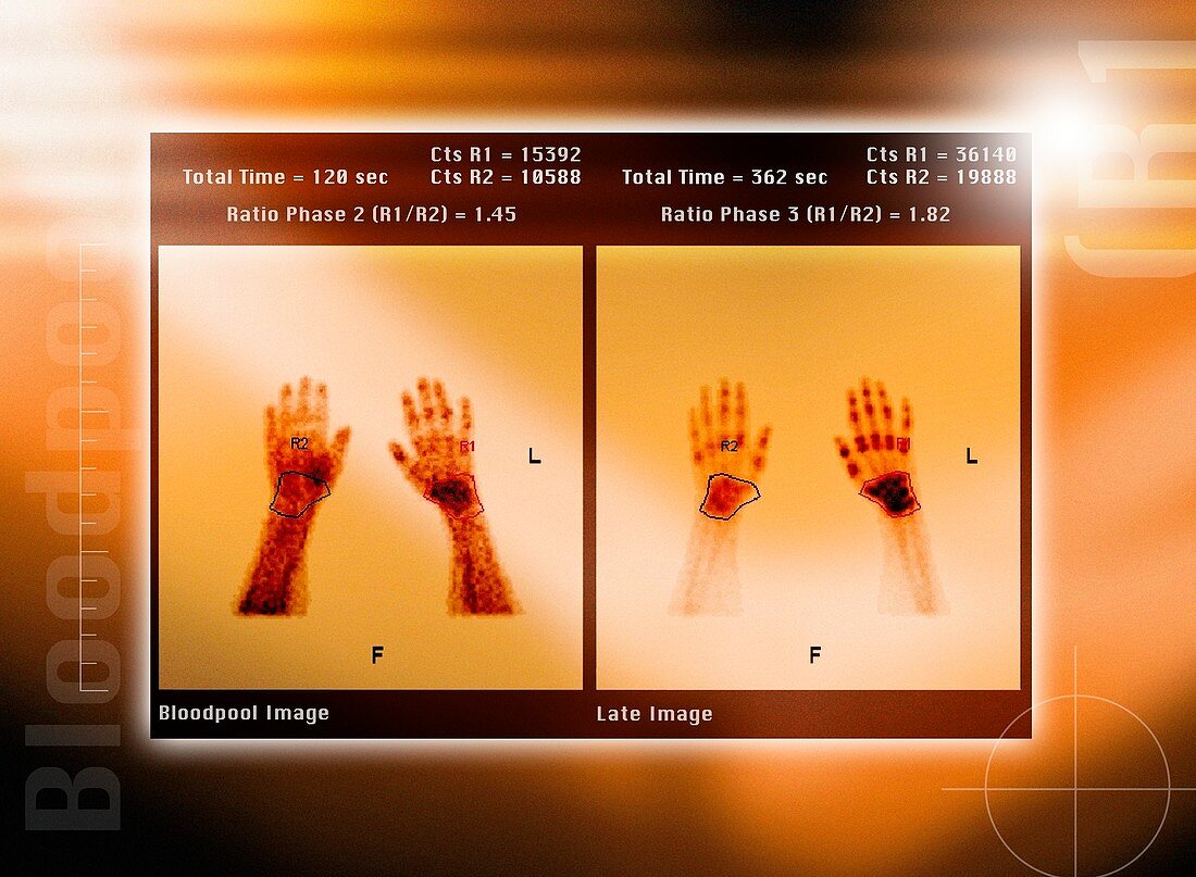 Arthritic hands,scintigram