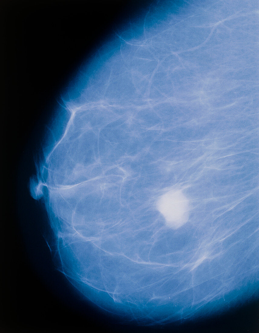 Mammogram showing non-invasive cancerous tumour