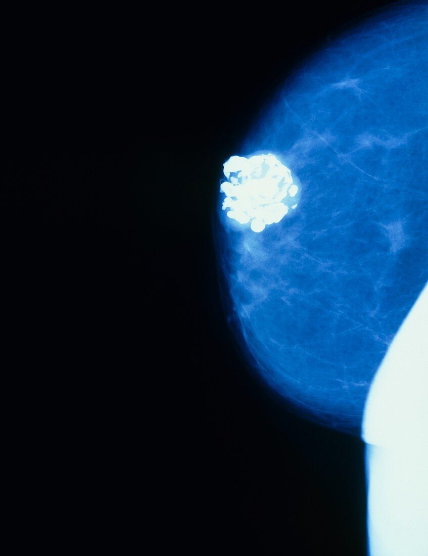 Mammogram of a female breast showing benign tumour