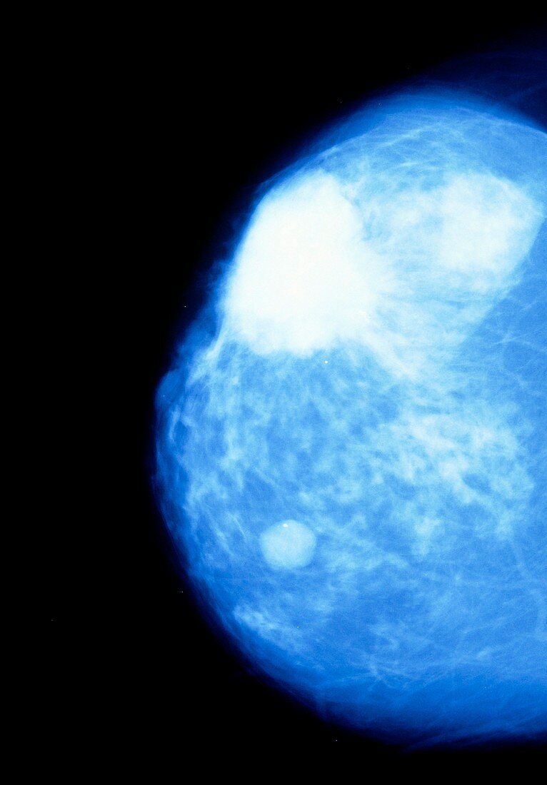 Mammogram showing canceous tumour in female breast