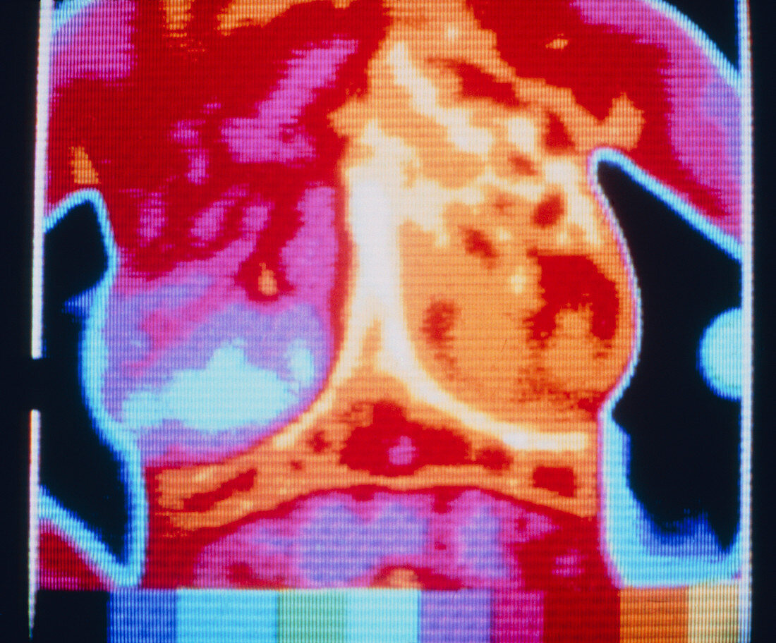 Thermogram of breast cancer