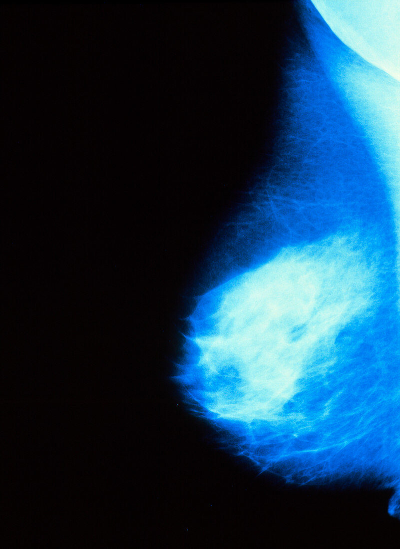 Mammogram normal mature breast (aged 40-45 years)