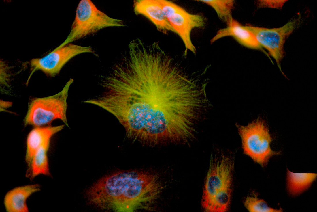 Immunofluorescent LM of human breast cancer cells